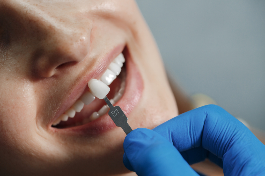How Long Does Dental Bonding Last