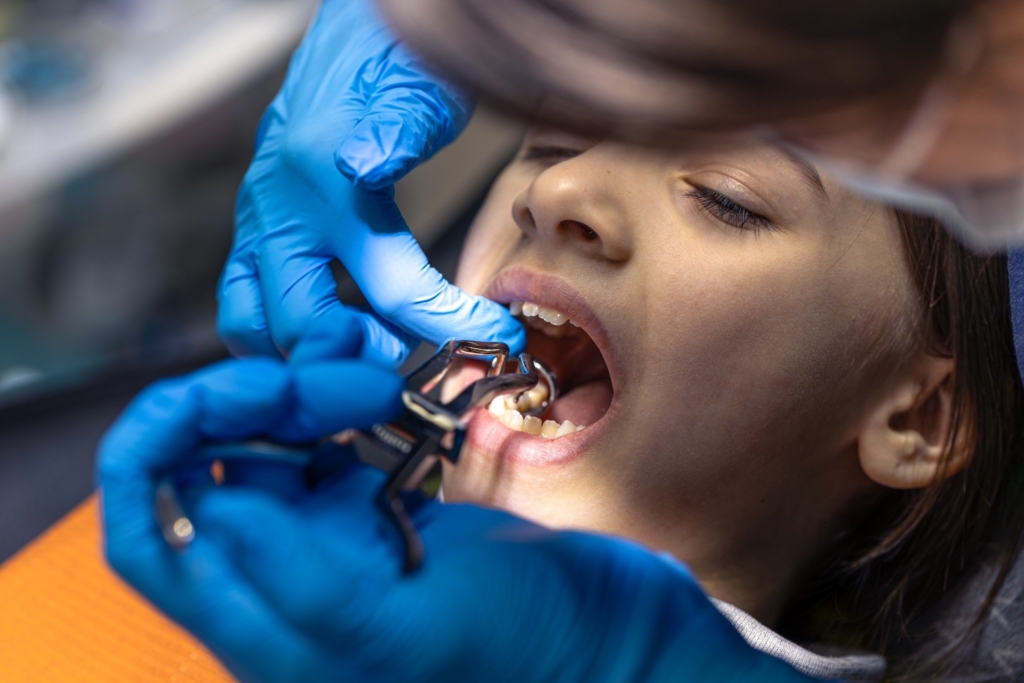 Dental Filling